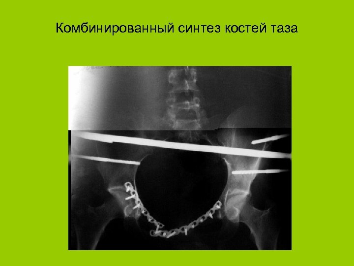 Комбинированный синтез костей таза 