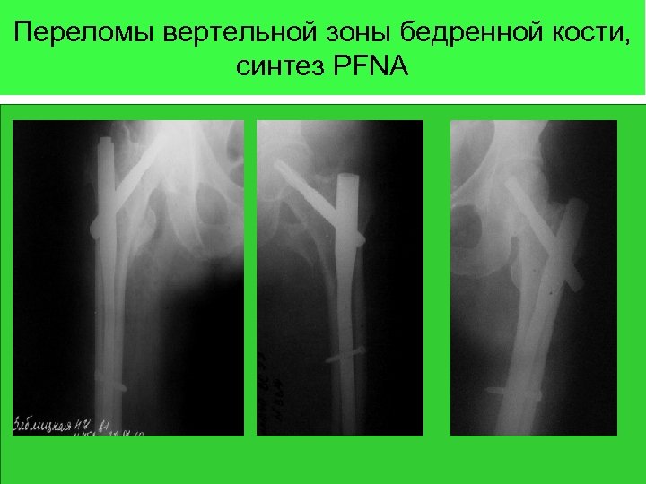 Переломы вертельной зоны бедренной кости, синтез PFNA 