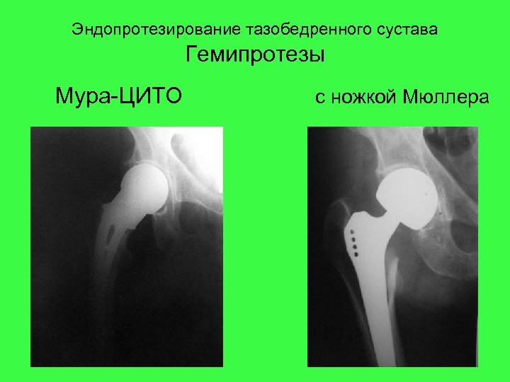 Эндопротезирование тазобедренного сустава Гемипротезы Мура-ЦИТО с ножкой Мюллера 