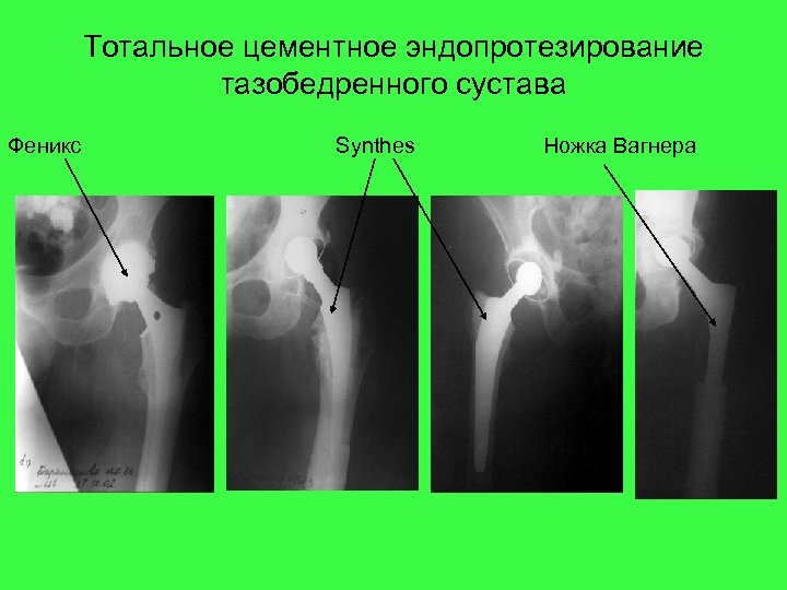 Тотальное цементное эндопротезирование тазобедренного сустава Феникс Synthes Ножка Вагнера 