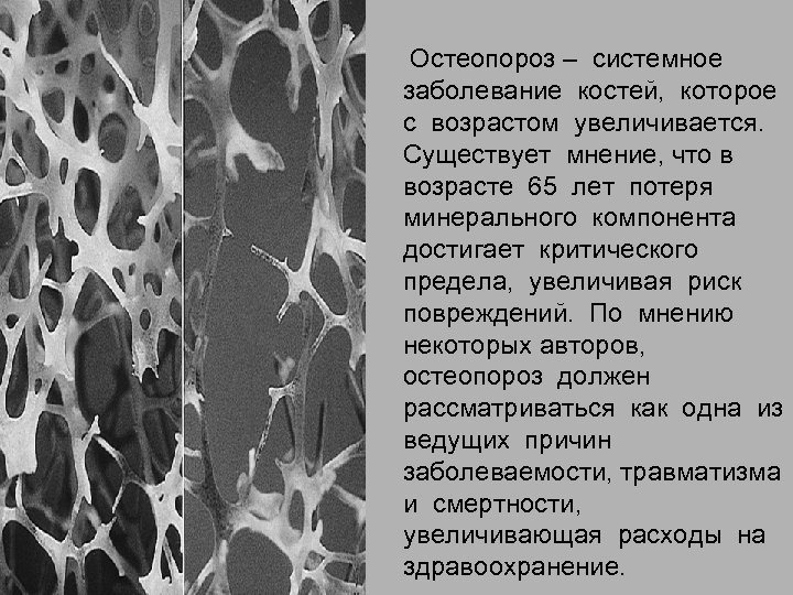 Остеопороз – системное заболевание костей, которое с возрастом увеличивается. Существует мнение, что в возрасте