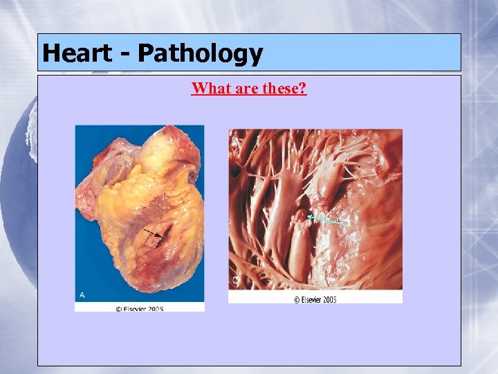 Heart - Pathology What are these? 