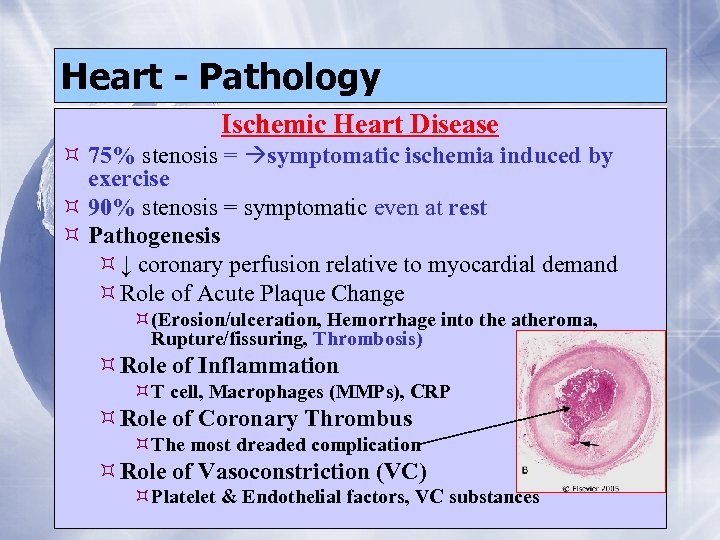 Heart - Pathology Ischemic Heart Disease 75% stenosis = symptomatic ischemia induced by exercise