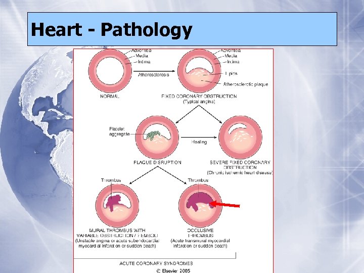 Heart - Pathology 