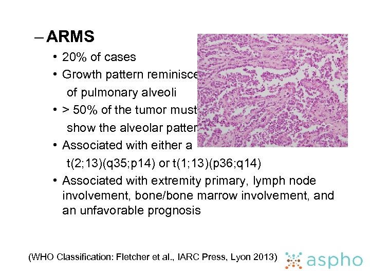 – ARMS • 20% of cases • Growth pattern reminiscent of pulmonary alveoli •