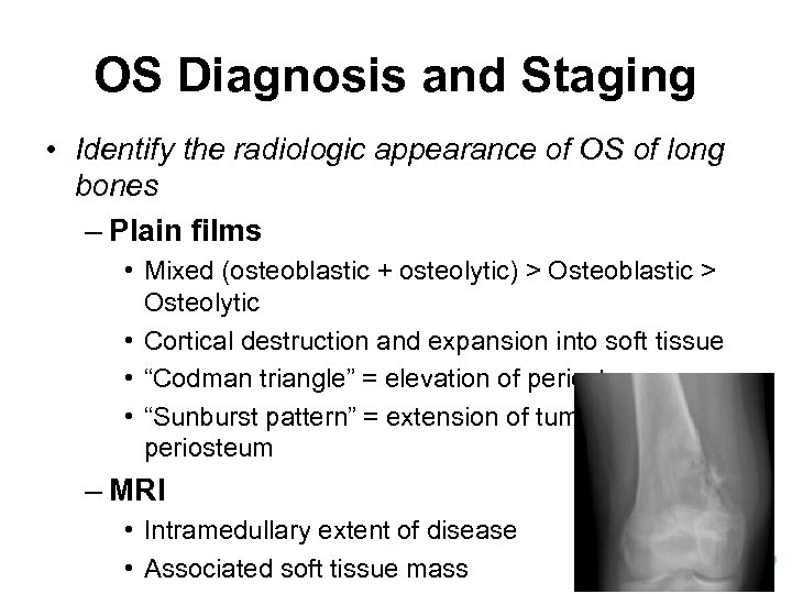OS Diagnosis and Staging • Identify the radiologic appearance of OS of long bones