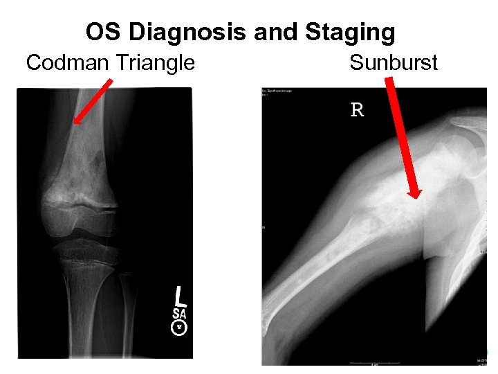 OS Diagnosis and Staging Codman Triangle Sunburst 