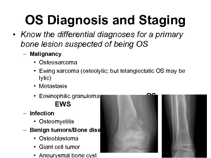 OS Diagnosis and Staging • Know the differential diagnoses for a primary bone lesion