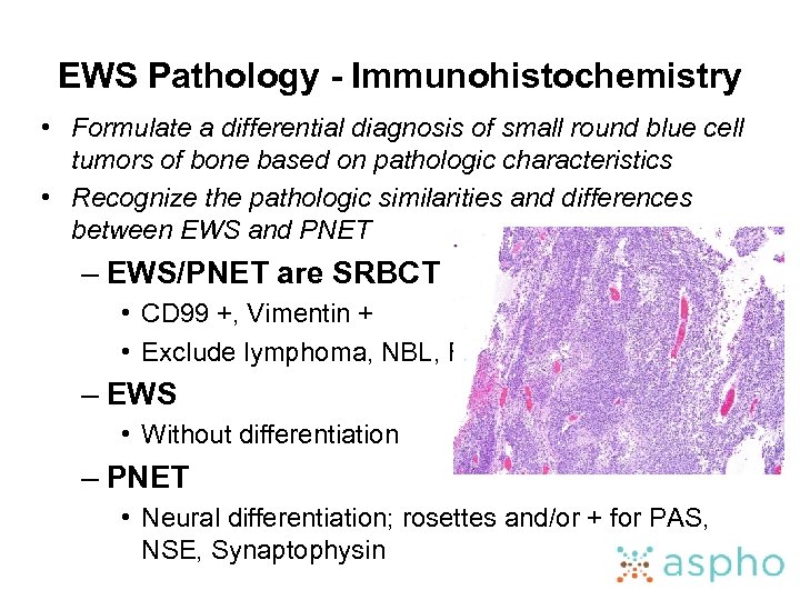 EWS Pathology - Immunohistochemistry • Formulate a differential diagnosis of small round blue cell
