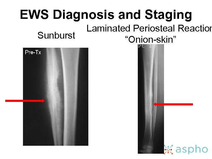 EWS Diagnosis and Staging Sunburst Laminated Periosteal Reaction “Onion-skin” 