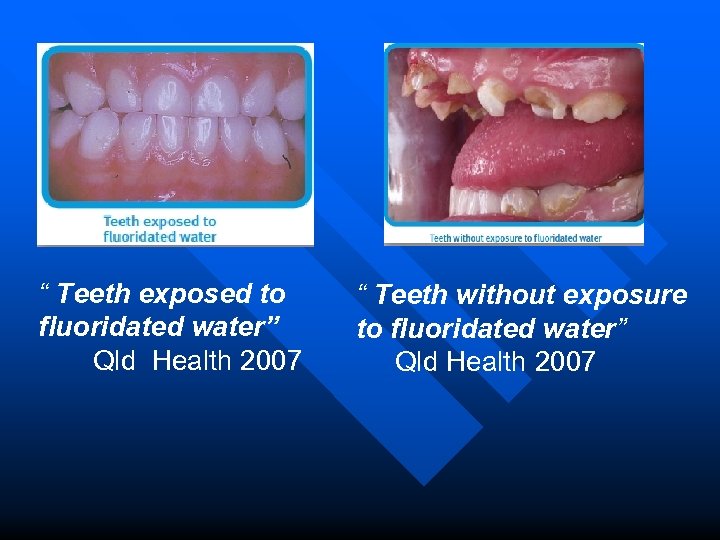 “ Teeth exposed to fluoridated water” Qld Health 2007 “ Teeth without exposure to