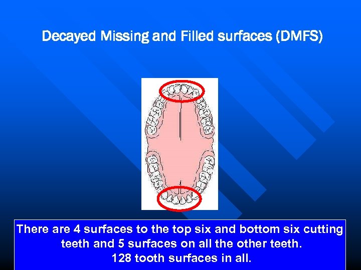 Decayed Missing and Filled surfaces (DMFS) There are 4 surfaces to the top six