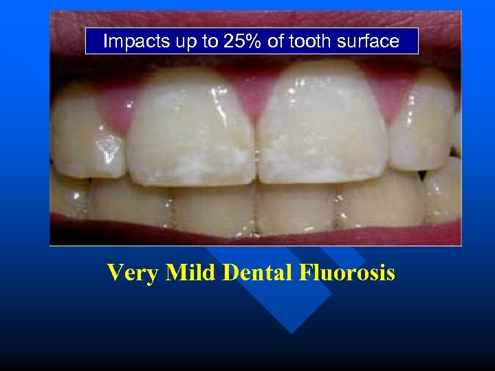 Impacts up to 25% of tooth surface Very Mild Dental Fluorosis 