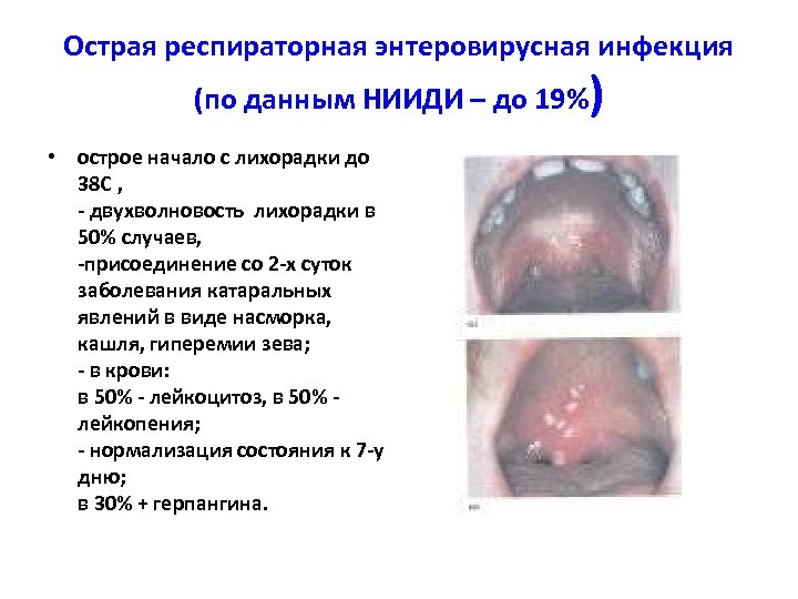 Острая респираторная энтеровирусная инфекция (по данным НИИДИ – до 19%) • острое начало с