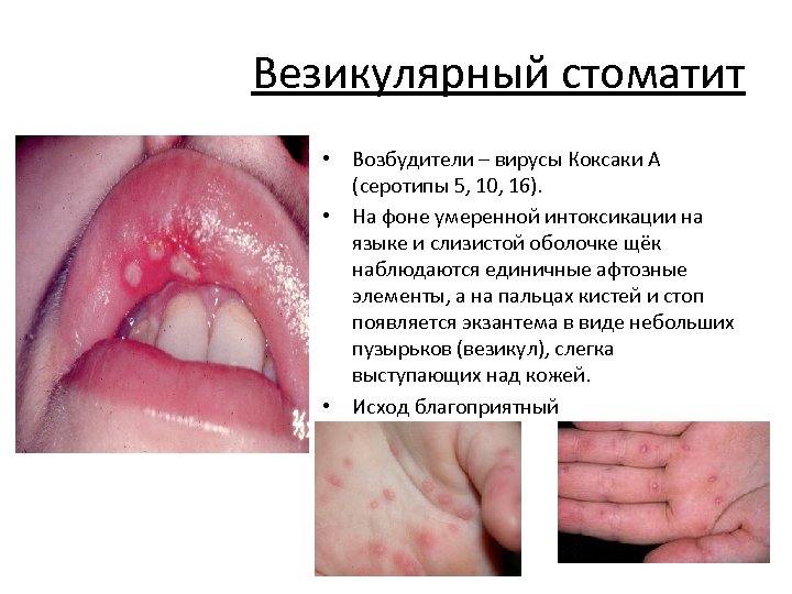 Везикулярный стоматит • Возбудители – вирусы Коксаки А (серотипы 5, 10, 16). • На