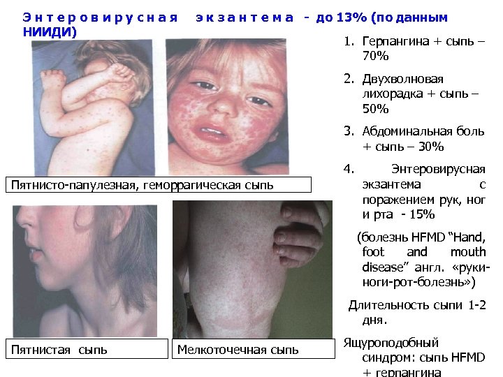 Энтеровирусная НИИДИ) э к з а н т е м а - до 13%