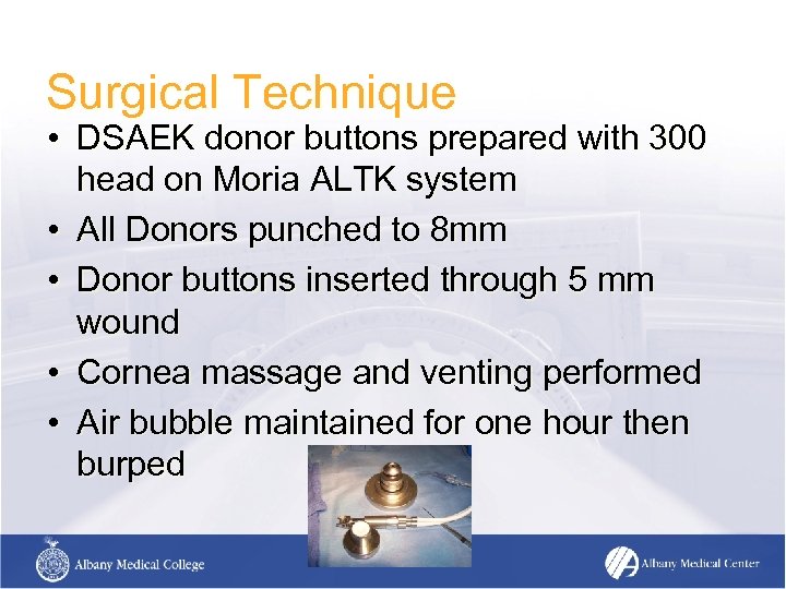 Surgical Technique • DSAEK donor buttons prepared with 300 head on Moria ALTK system