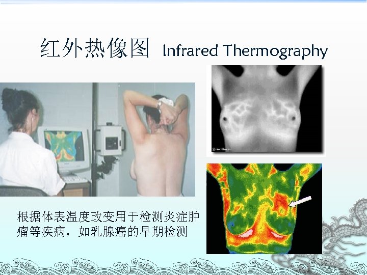 红外热像图 Infrared Thermography 根据体表温度改变用于检测炎症肿 瘤等疾病，如乳腺癌的早期检测 