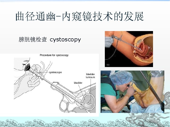 曲径通幽-内窥镜技术的发展 膀胱镜检查 cystoscopy 