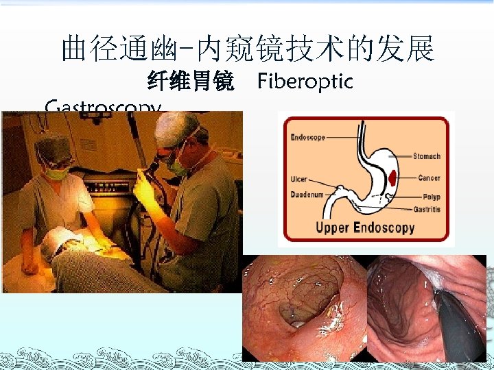 曲径通幽-内窥镜技术的发展 纤维胃镜 Gastroscopy Fiberoptic 