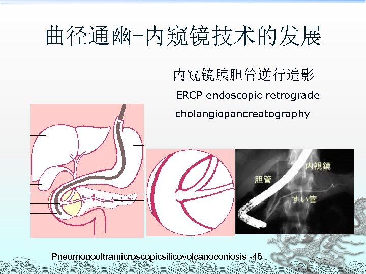 曲径通幽-内窥镜技术的发展 内窥镜胰胆管逆行造影 ERCP endoscopic retrograde cholangiopancreatography Pneumonoultramicroscopicsilicovolcanoconiosis -45 