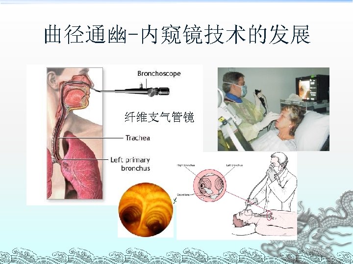 曲径通幽-内窥镜技术的发展 纤维支气管镜 