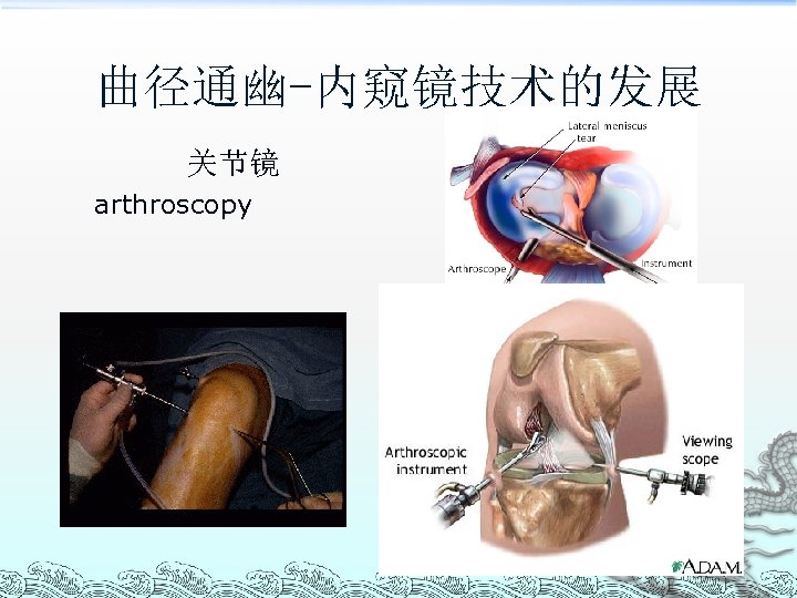 曲径通幽-内窥镜技术的发展 关节镜 arthroscopy 