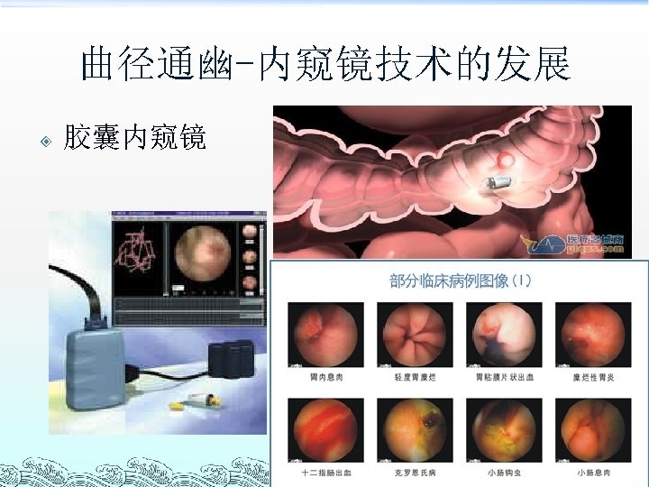 曲径通幽-内窥镜技术的发展 胶囊内窥镜 