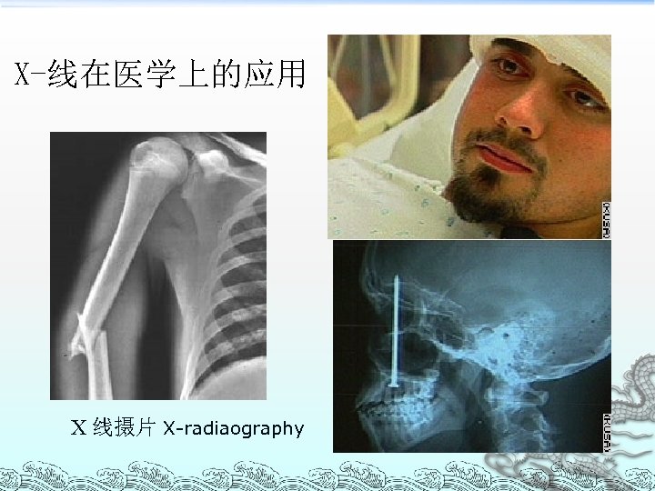 X-线在医学上的应用 X 线摄片 X-radiaography 