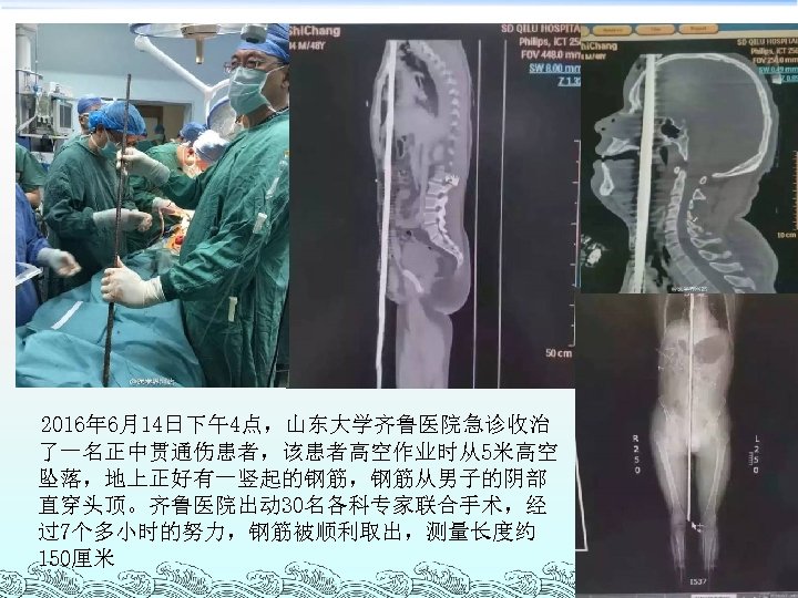 2016年 6月14日下午4点，山东大学齐鲁医院急诊收治 了一名正中贯通伤患者，该患者高空作业时从5米高空 坠落，地上正好有一竖起的钢筋，钢筋从男子的阴部 直穿头顶。齐鲁医院出动 30名各科专家联合手术，经 过7个多小时的努力，钢筋被顺利取出，测量长度约 150厘米 