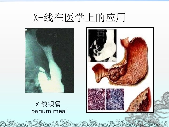 X-线在医学上的应用 X 线钡餐 barium meal 