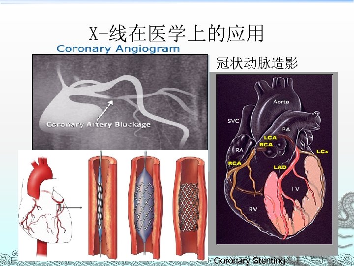 X-线在医学上的应用 冠状动脉造影 Coronary Stenting 