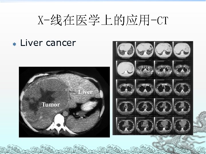 X-线在医学上的应用-CT ß Liver cancer 