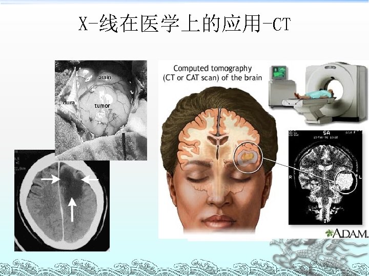 X-线在医学上的应用-CT cerebral infarct 