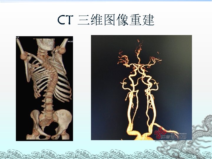 CT 三维图像重建 