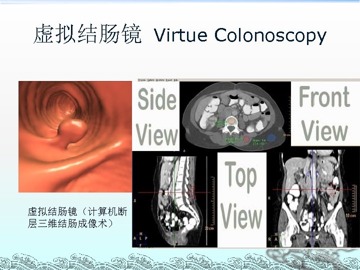 虚拟结肠镜 Virtue Colonoscopy 虚拟结肠镜（计算机断 层三维结肠成像术） 