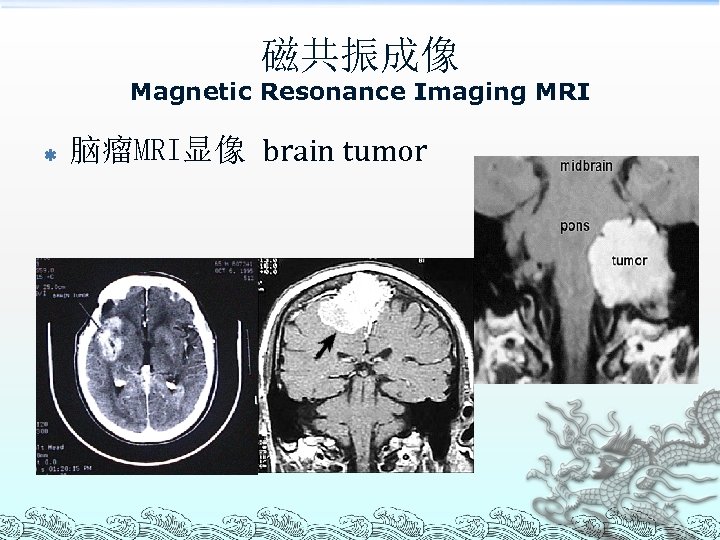 磁共振成像 Magnetic Resonance Imaging MRI ß 脑瘤MRI显像 brain tumor 