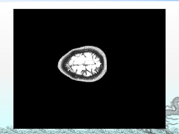 磁共振成像 Magnetic Resonance Imaging MRI 