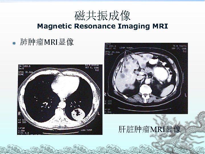 磁共振成像 Magnetic Resonance Imaging MRI ß 肺肿瘤MRI显像 肝脏肿瘤MRI显像 