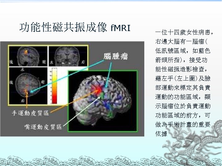功能性磁共振成像 f. MRI 一位十四歲女性病患， 右邊大腦有一腦瘤( 低訊號區域，如藍色 箭頭所指)，接受功 能性磁振造影檢查， 藉左手(左上圖)及臉 部運動來標定其負責 運動的功能區域，顯 示腦瘤位於負責運動 功能區域的前方，可 做為手術計畫的重要