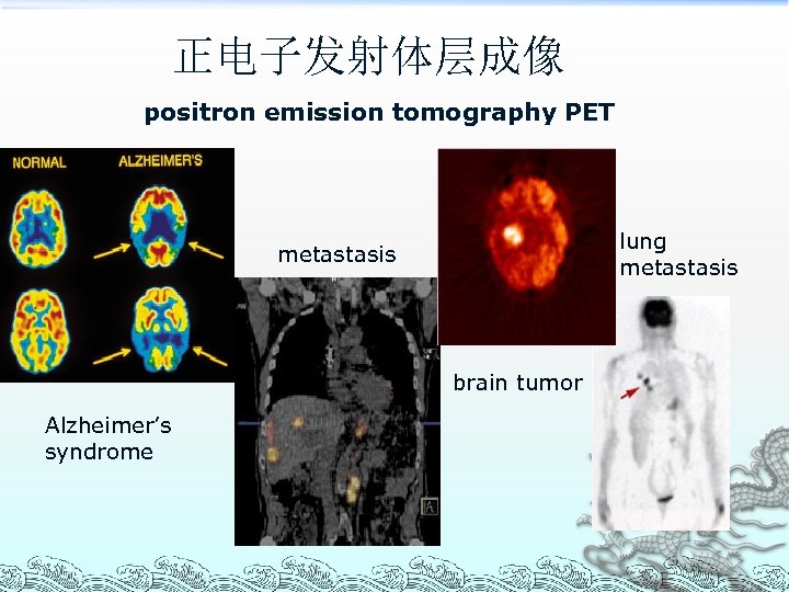 正电子发射体层成像 positron emission tomography PET lung metastasis brain tumor Alzheimer’s syndrome 