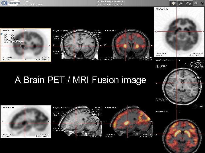 A Brain PET / MRI Fusion image 