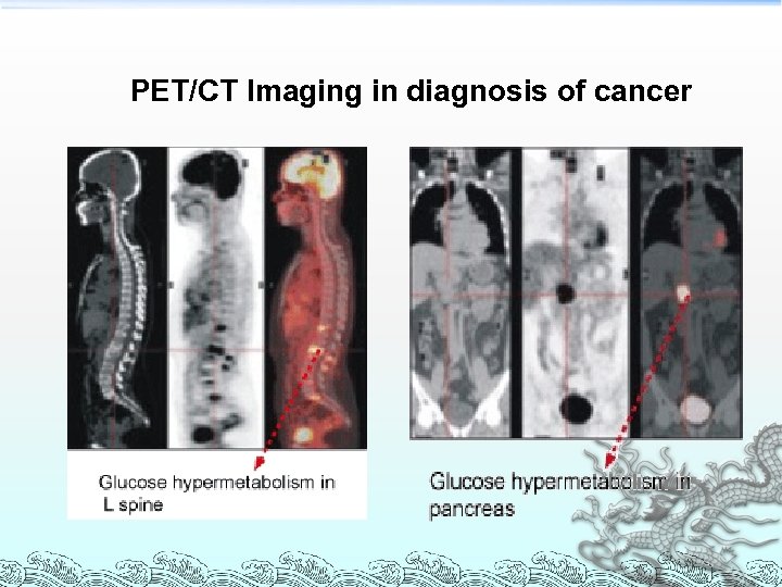 PET/CT Imaging in diagnosis of cancer 