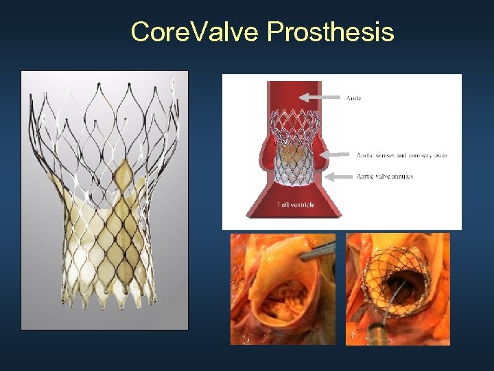 Core. Valve Prosthesis 