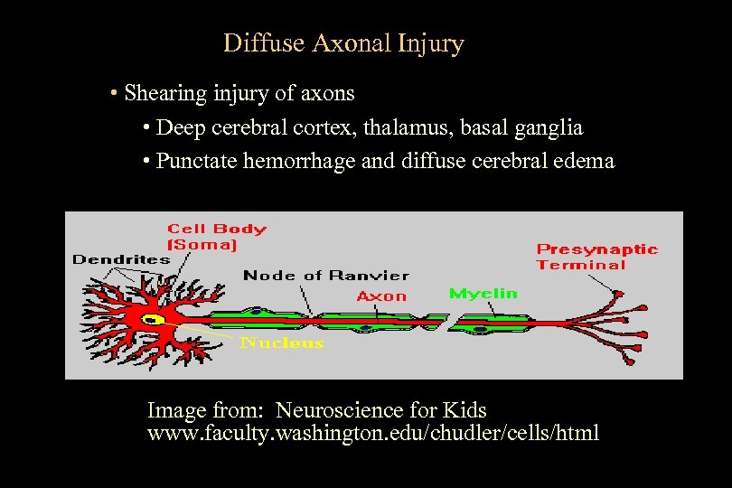 Diffuse Axonal Injury • Shearing injury of axons • Deep cerebral cortex, thalamus, basal