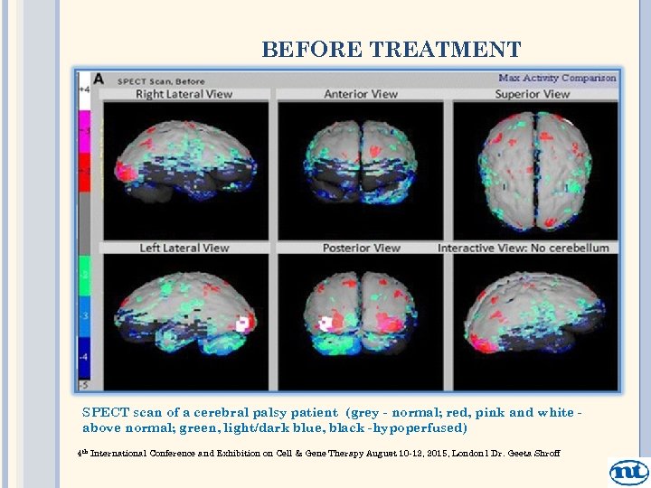 BEFORE TREATMENT SPECT scan of a cerebral palsy patient (grey - normal; red, pink