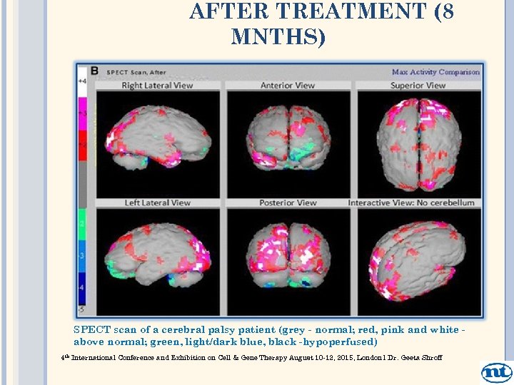 AFTER TREATMENT (8 MNTHS) SPECT scan of a cerebral palsy patient (grey - normal;