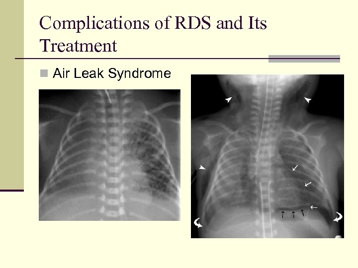 Complications of RDS and Its Treatment n Air Leak Syndrome 