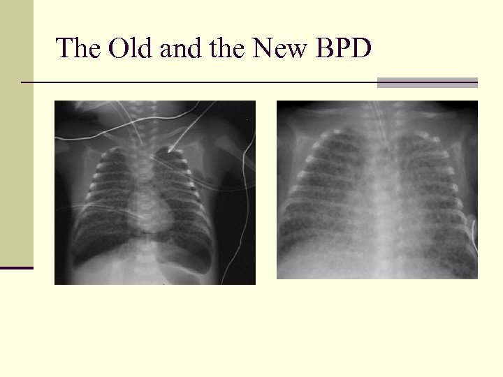 The Old and the New BPD 