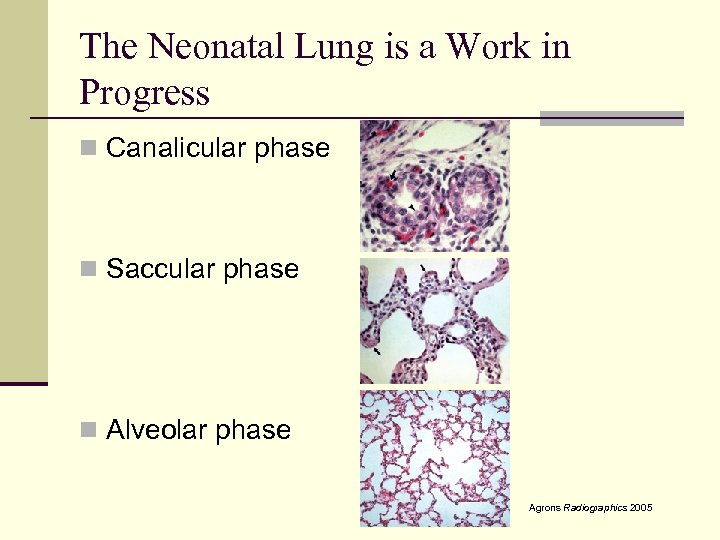 The Neonatal Lung is a Work in Progress n Canalicular phase n Saccular phase